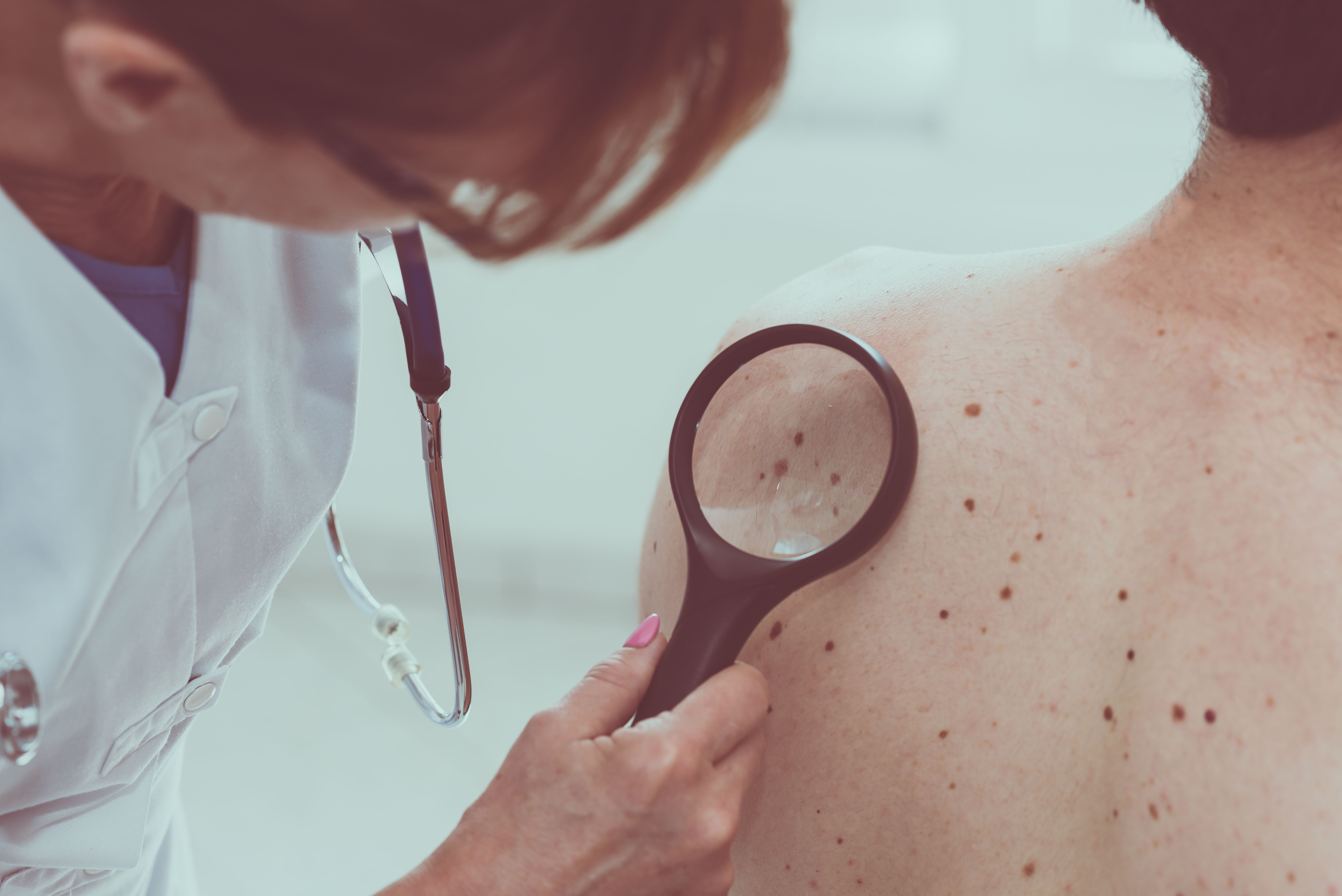 The cause of melanoma beyond UV rays is why a skin examination is needed