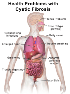 Blausen_0286_CysticFibrosis[1]