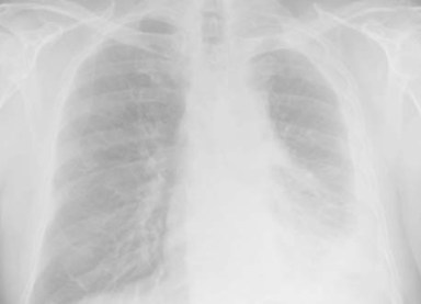 Mesothelioma-web