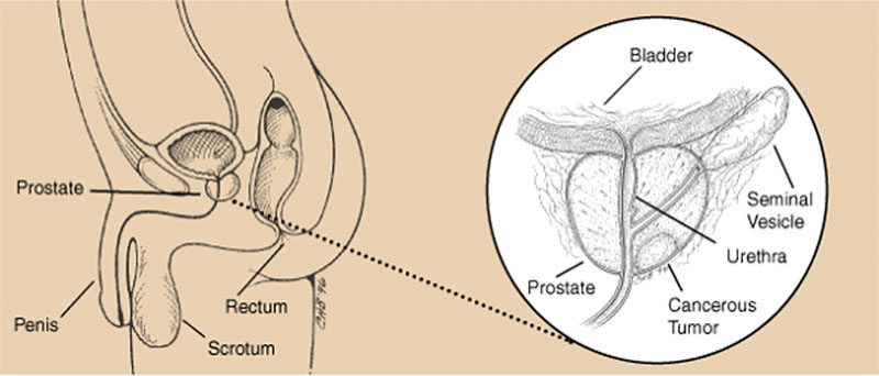 Prostate_A