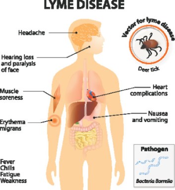 lyme disease