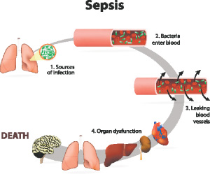 sepsis